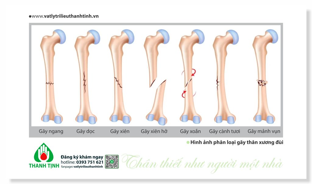 Gẫy thân xương đùi -Mô tả chi tiết