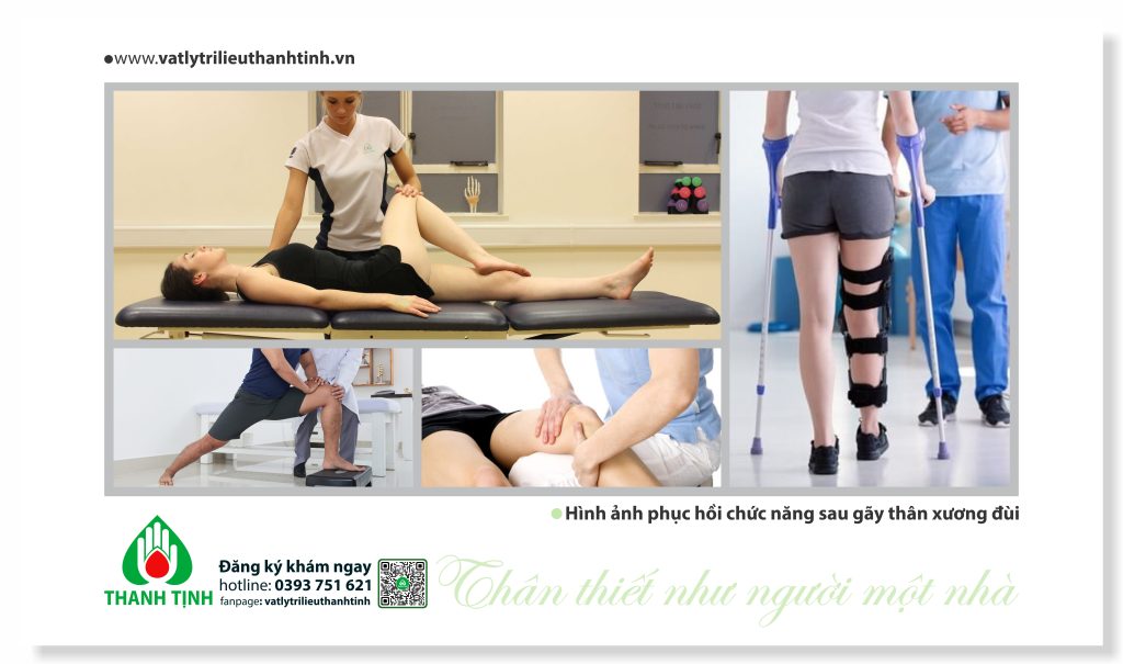 Phục hồi chức năng sau phẫu thuật gẫy thân xương đùi