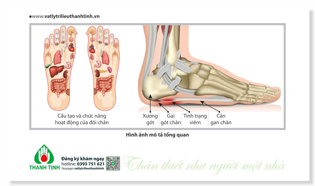 Gai gót chân - Mô tả chi tiết